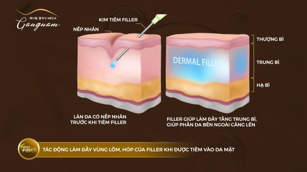 trai-nghiem-tiem-filler