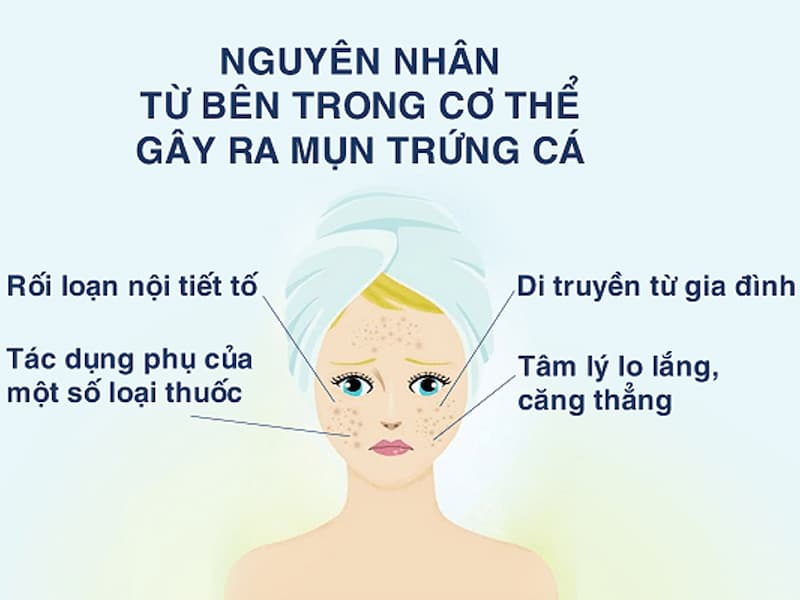 nguyen-nhan-ben-trong-co-the-gay-ra-mun-trung-ca