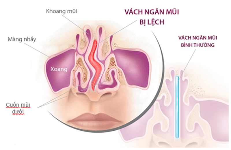 phau-thuat-veo-vach-ngan-mui-la-gi-1