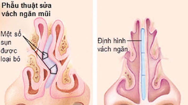 phau-thuat-veo-vach-ngan-mui-la-gi