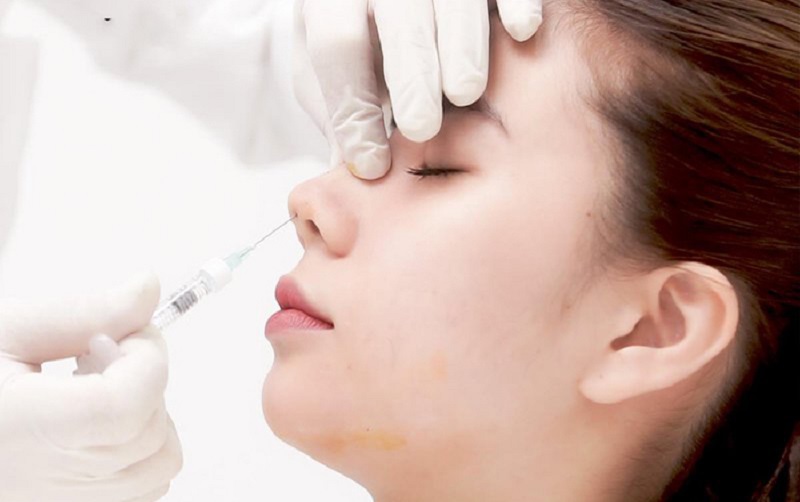 Filler là chất làm đầy sinh học được tiêm vào để giúp nâng cao sống mũi