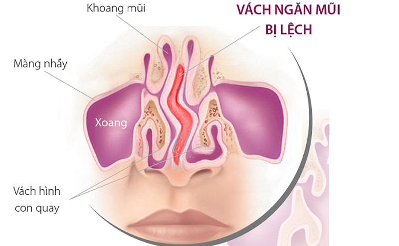 veo-vach-ngan-mui