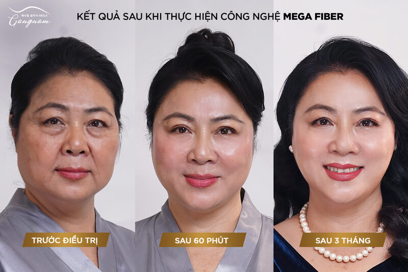 Ly-do-nen-thuc-hien-dich-vu-Mega Fiber-tai-phong-kham-quoc-te-Mega Gangnam