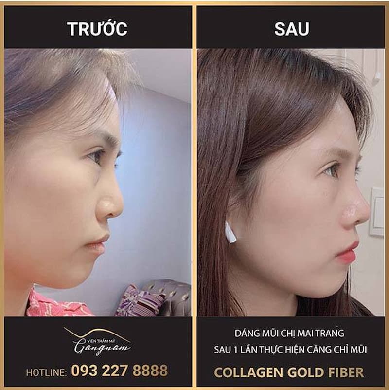 hinh-anh-truoc-va-sau-khi-nang-mui-cang-chi-collagen-gold-fiber