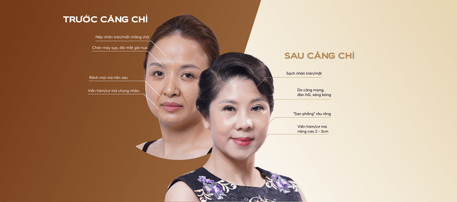 truoc-va-sau-khi-cang-chi-Collagen-Gold-Fiber