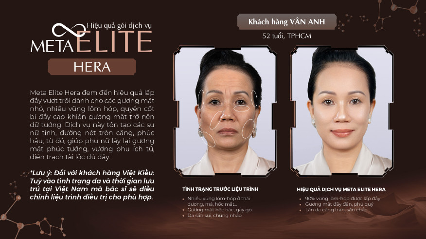 Khách hàng trước - sau khi thực hiện dịch vụ Meta Elite